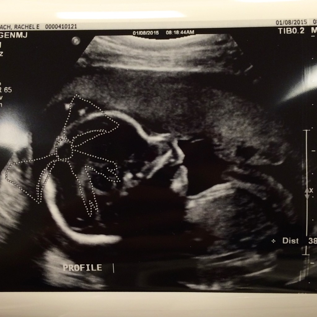 It's a Girl - 20 Week Ultrasound